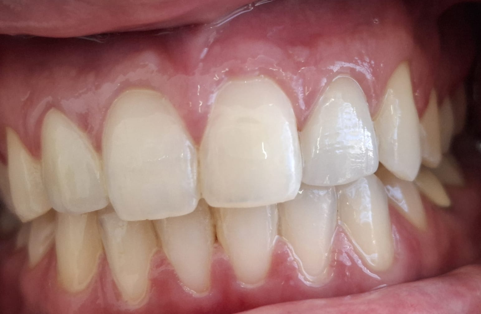 Depois - Reabilitação Estética Anterior